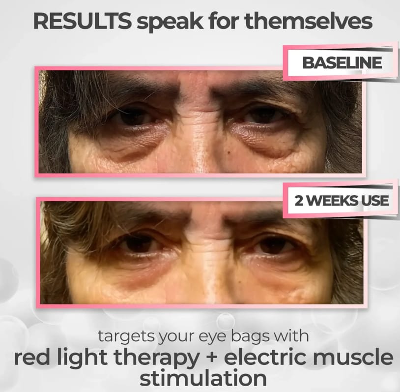 Red Light Therapy for Eyes Bags, Puffiness & Dark Circles